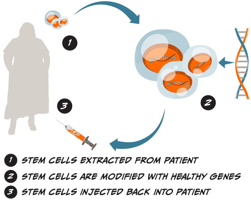 Illustrative diagram showing three steps for how cell-based gene therapy works. One, stem cells are extracted from a patient, the cells and patient are illustrated with an arrow pointing to the next step. Two, stem cells are modified with healthy genes, a larger cluster of stem cells are illustrated, with healthy genes being inserted into them, and an arrow pointing to the final step. Three, stem cells are injected back into the patient, with a syringe illustrated near the illustration of the patient.